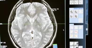 Ein Bild eines MRT, das ein Bild eines Gehirns zeigt.