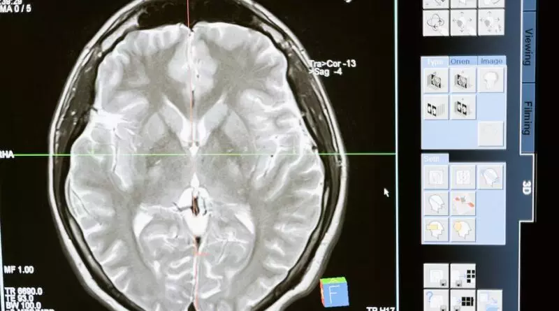Ein Bild eines MRT, das ein Bild eines Gehirns zeigt.